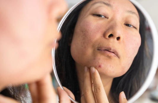 Woman putting on skincare for her inflamed skin