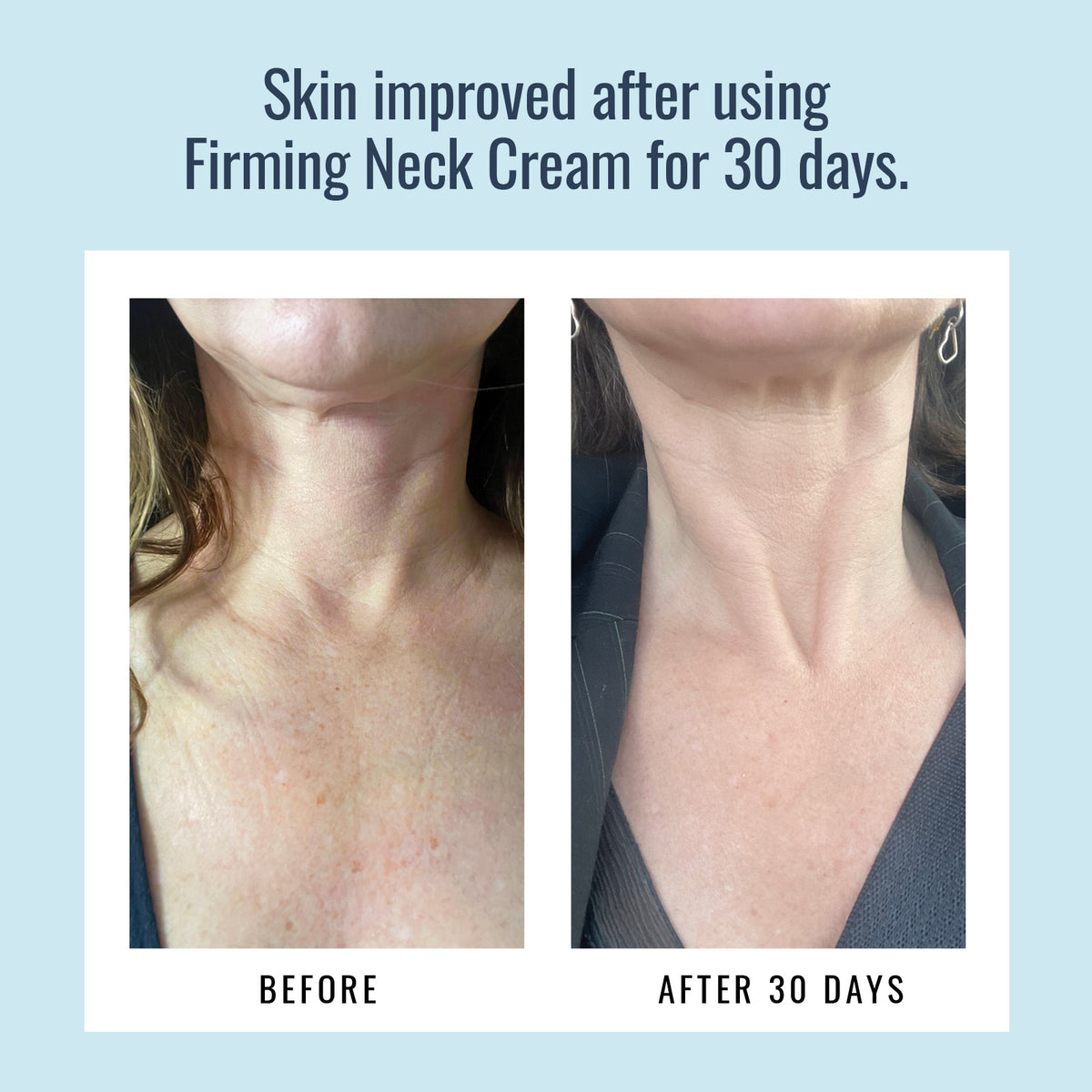Before and after using Foundation Skincare Neck Firming Cream after 30 days.
