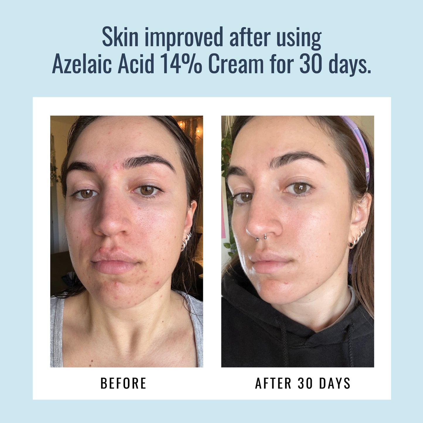 Before & After Images Using Azelaic Acid 14% Cream from Foundation Skincare