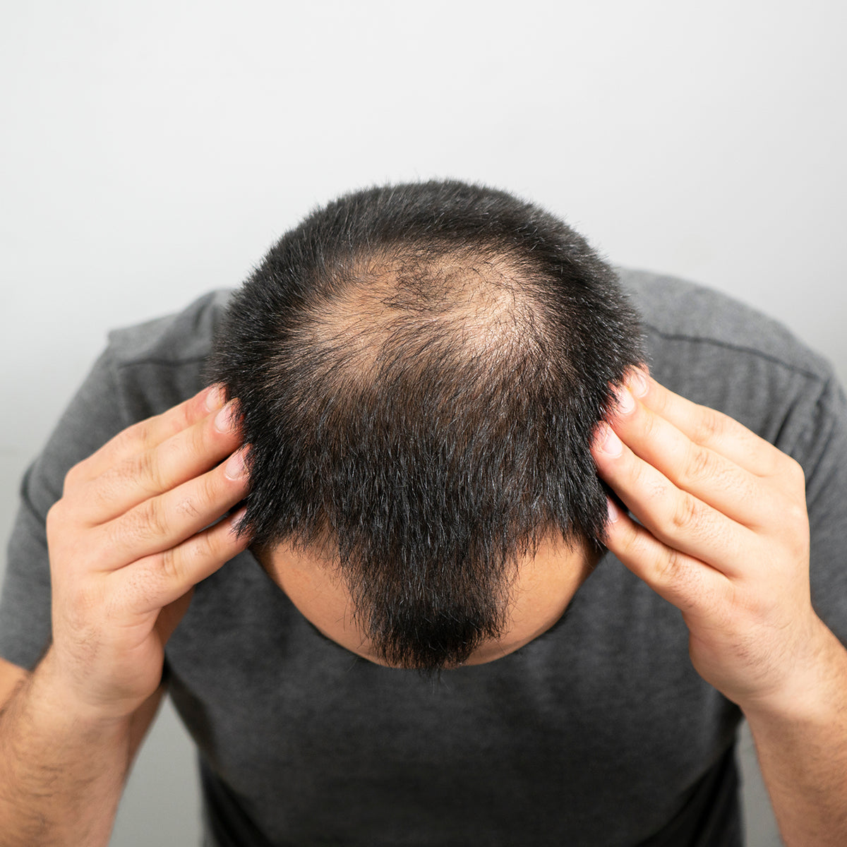 Man who is suffering from male-patterned baldness