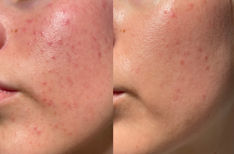 5 Ways to Improve Skin Texture