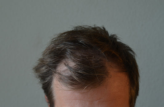 What Causes A Receding Hair Line in Men