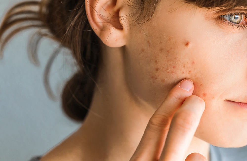 Azelaic Acid: What It Is & Best Ways To Use It