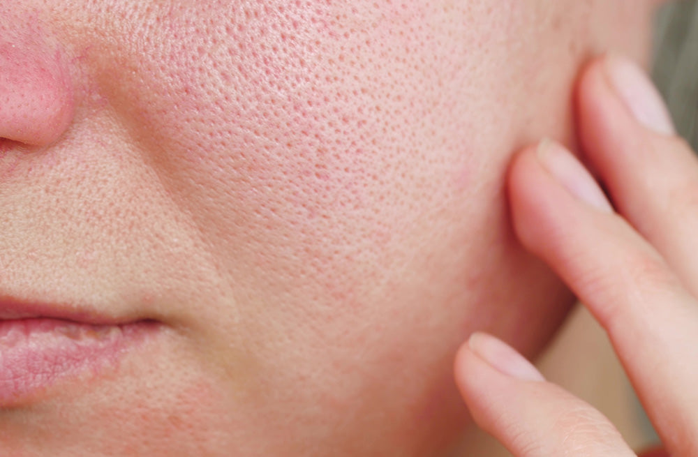 Enlarged pores