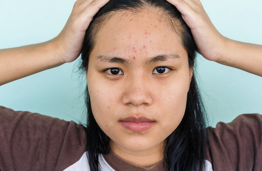 Asian women with acne on forehead