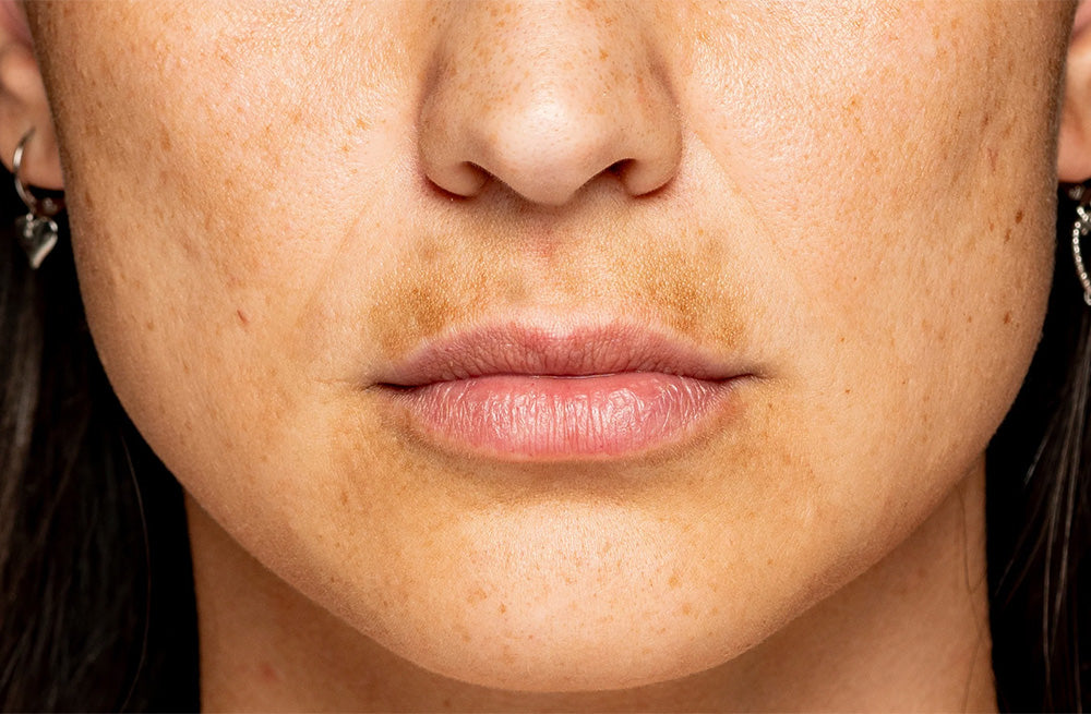 Face with melasma mustache