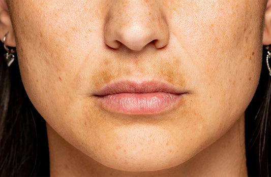 Face with melasma mustache