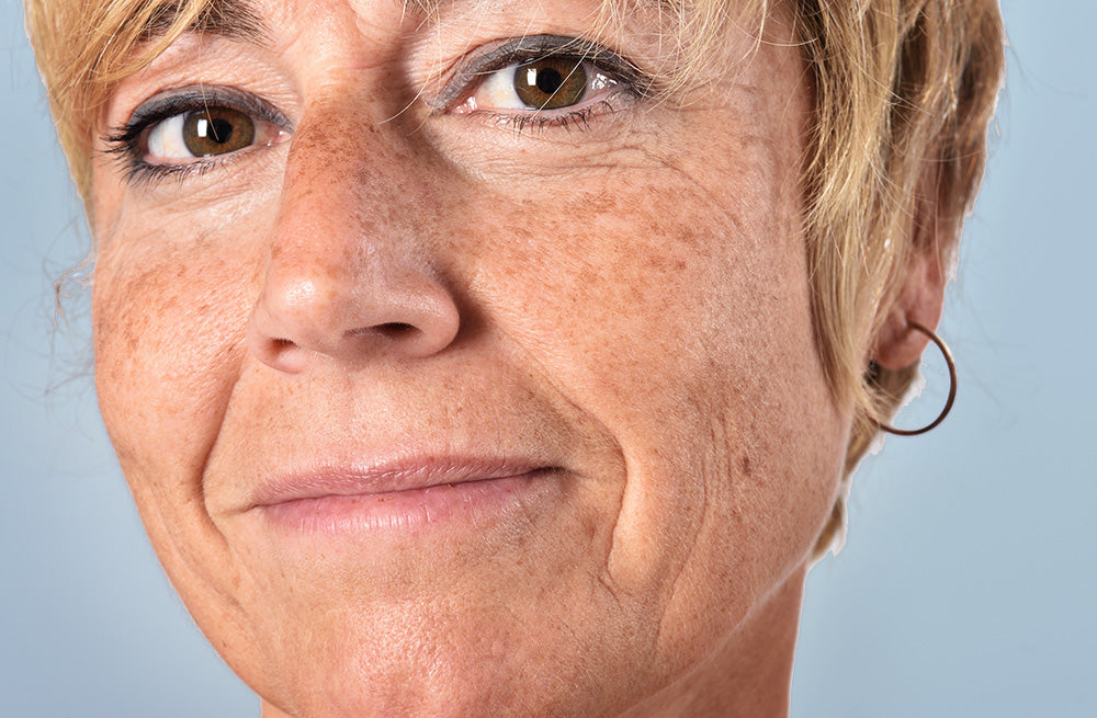 Melasma 101: Causes, Symptoms & How To Treat It