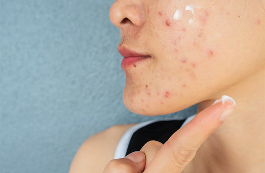 Profile of cheek acne