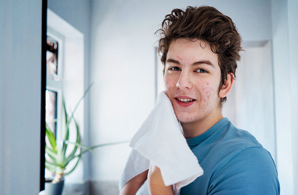 Top 5 Skincare Products You Need for Acne Breakouts & Scarring