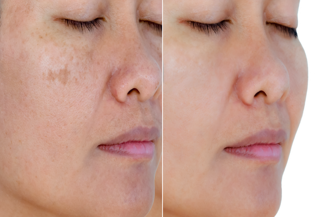 Best Skincare Products to Help Get Rid of Dark Spots