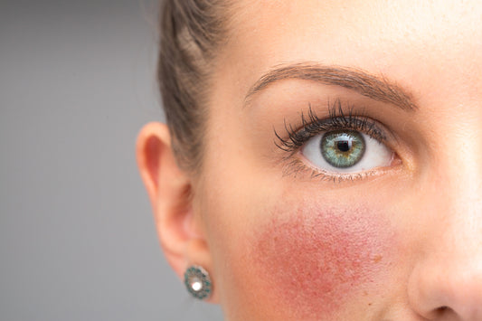 How Your Diet Can Help Reduce Rosacea Flare-Ups